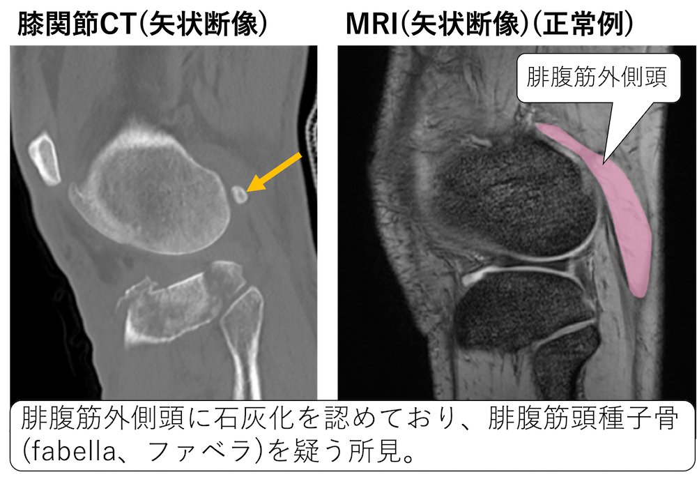 腓腹筋頭種子骨(fabella、ファベラ)の画像診断のポイント！大腿骨後方 